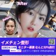 韓国ソウルで整形モデル募集［トップフェイス整形外科］に関する画像です。
