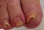 巻き爪や陥入爪の痛みを爪の矯正治療で改善します